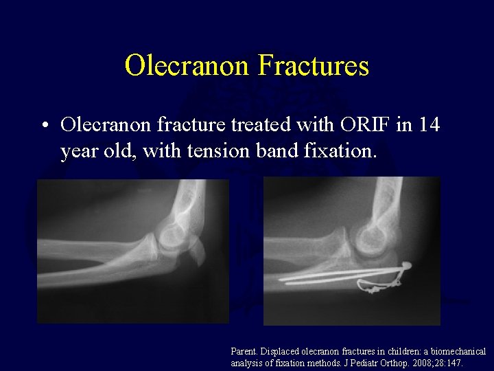 Olecranon Fractures • Olecranon fracture treated with ORIF in 14 year old, with tension Olecranon Fractures • Olecranon fracture treated with ORIF in 14 year old, with tension