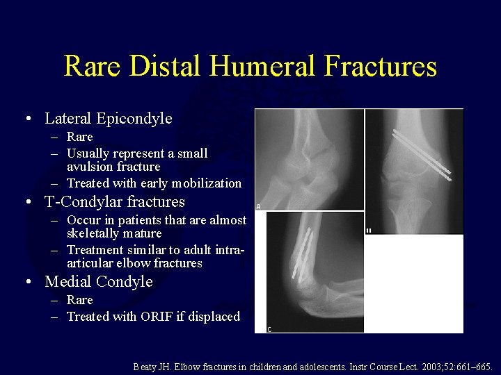 Rare Distal Humeral Fractures • Lateral Epicondyle – Rare – Usually represent a small Rare Distal Humeral Fractures • Lateral Epicondyle – Rare – Usually represent a small