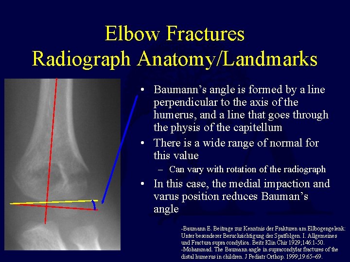Elbow Fractures Radiograph Anatomy/Landmarks • Baumann’s angle is formed by a line perpendicular to Elbow Fractures Radiograph Anatomy/Landmarks • Baumann’s angle is formed by a line perpendicular to