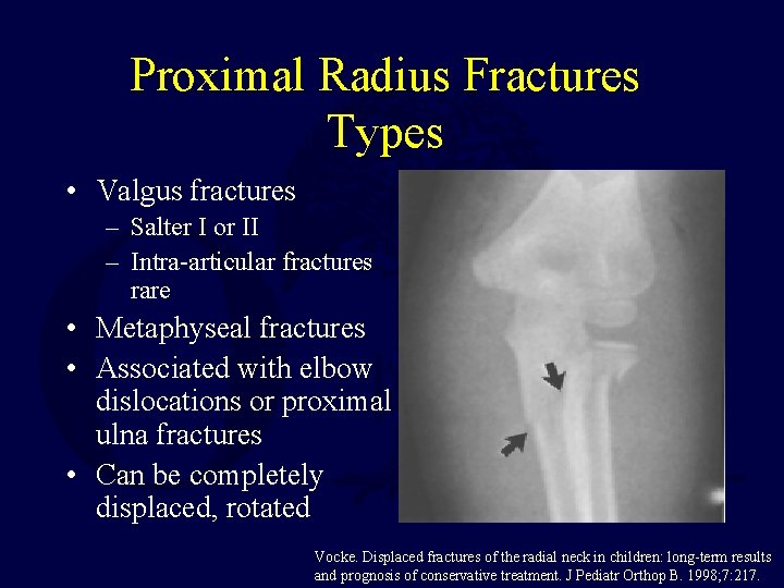 Proximal Radius Fractures Types • Valgus fractures – Salter I or II – Intra-articular Proximal Radius Fractures Types • Valgus fractures – Salter I or II – Intra-articular