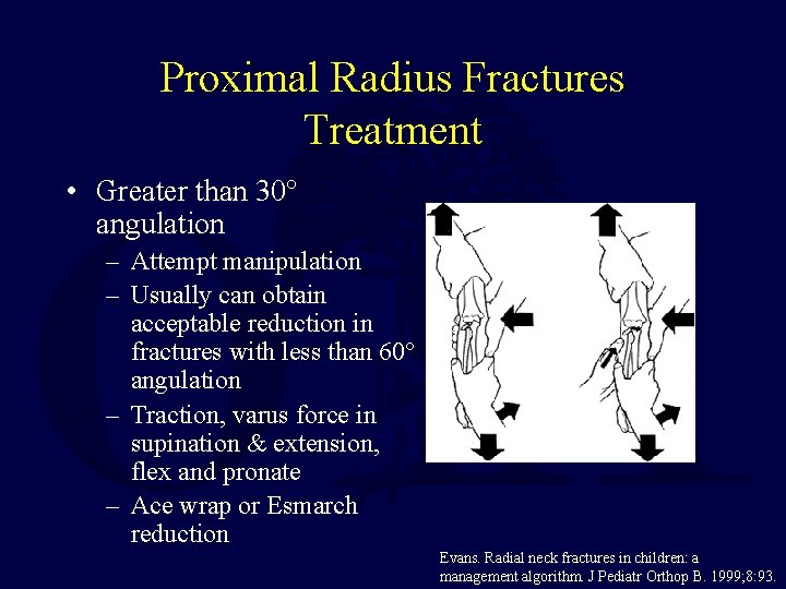Proximal Radius Fractures Treatment • Greater than 30° angulation – Attempt manipulation – Usually Proximal Radius Fractures Treatment • Greater than 30° angulation – Attempt manipulation – Usually