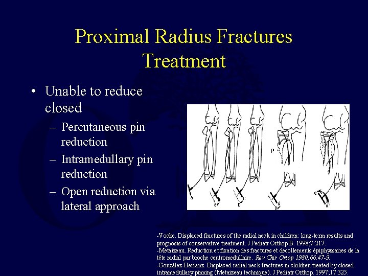 Proximal Radius Fractures Treatment • Unable to reduce closed – Percutaneous pin reduction – Proximal Radius Fractures Treatment • Unable to reduce closed – Percutaneous pin reduction –
