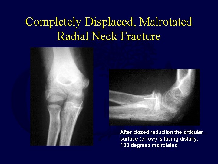 Completely Displaced, Malrotated Radial Neck Fracture After closed reduction the articular surface (arrow) is Completely Displaced, Malrotated Radial Neck Fracture After closed reduction the articular surface (arrow) is