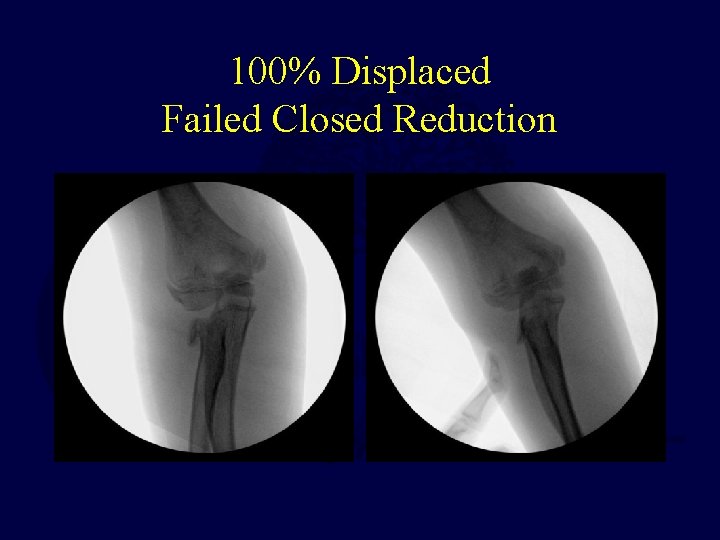 100% Displaced Failed Closed Reduction  100% Displaced Failed Closed Reduction