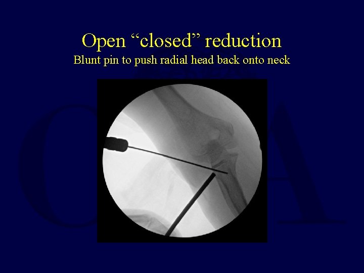 Open “closed” reduction Blunt pin to push radial head back onto neck  Open “closed” reduction Blunt pin to push radial head back onto neck