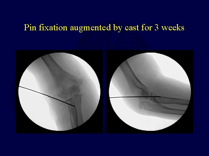 Pin fixation augmented by cast for 3 weeks  Pin fixation augmented by cast for 3 weeks