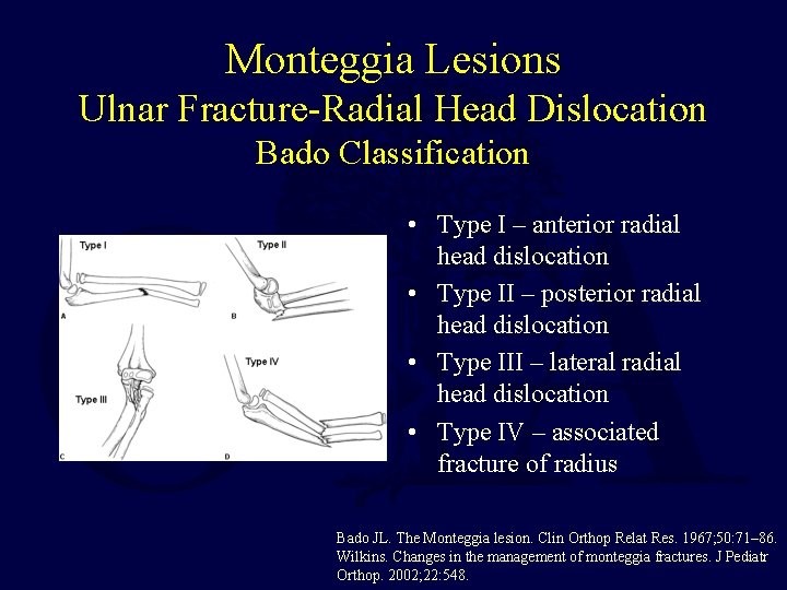 Monteggia Lesions Ulnar Fracture-Radial Head Dislocation Bado Classification • Type I – anterior radial Monteggia Lesions Ulnar Fracture-Radial Head Dislocation Bado Classification • Type I – anterior radial