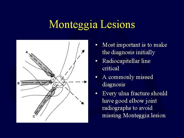 Monteggia Lesions • Most important is to make the diagnosis initially • Radiocapitellar line Monteggia Lesions • Most important is to make the diagnosis initially • Radiocapitellar line