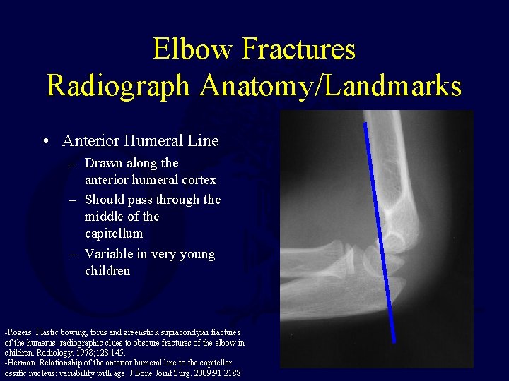 Elbow Fractures Radiograph Anatomy/Landmarks • Anterior Humeral Line – Drawn along the anterior humeral Elbow Fractures Radiograph Anatomy/Landmarks • Anterior Humeral Line – Drawn along the anterior humeral