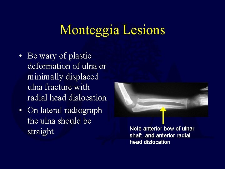 Monteggia Lesions • Be wary of plastic deformation of ulna or minimally displaced ulna Monteggia Lesions • Be wary of plastic deformation of ulna or minimally displaced ulna