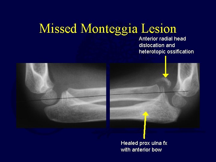 Missed Monteggia Lesion Anterior radial head dislocation and heterotopic ossification Healed prox ulna fx Missed Monteggia Lesion Anterior radial head dislocation and heterotopic ossification Healed prox ulna fx
