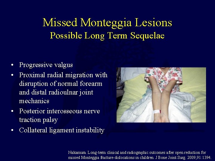 Missed Monteggia Lesions Possible Long Term Sequelae • Progressive valgus • Proximal radial migration Missed Monteggia Lesions Possible Long Term Sequelae • Progressive valgus • Proximal radial migration