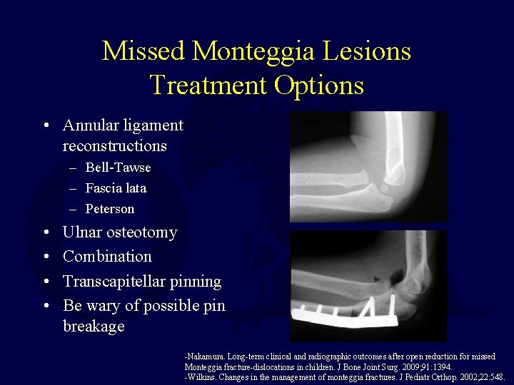 Missed Monteggia Lesions Treatment Options • Annular ligament reconstructions – Bell-Tawse – Fascia lata Missed Monteggia Lesions Treatment Options • Annular ligament reconstructions – Bell-Tawse – Fascia lata
