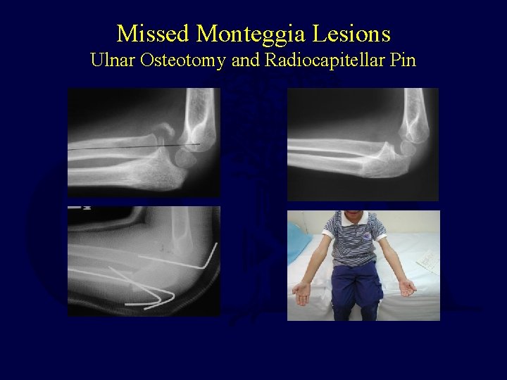 Missed Monteggia Lesions Ulnar Osteotomy and Radiocapitellar Pin  Missed Monteggia Lesions Ulnar Osteotomy and Radiocapitellar Pin