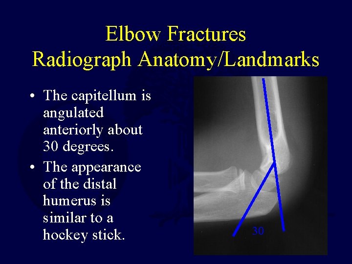 Elbow Fractures Radiograph Anatomy/Landmarks • The capitellum is angulated anteriorly about 30 degrees. • Elbow Fractures Radiograph Anatomy/Landmarks • The capitellum is angulated anteriorly about 30 degrees. •