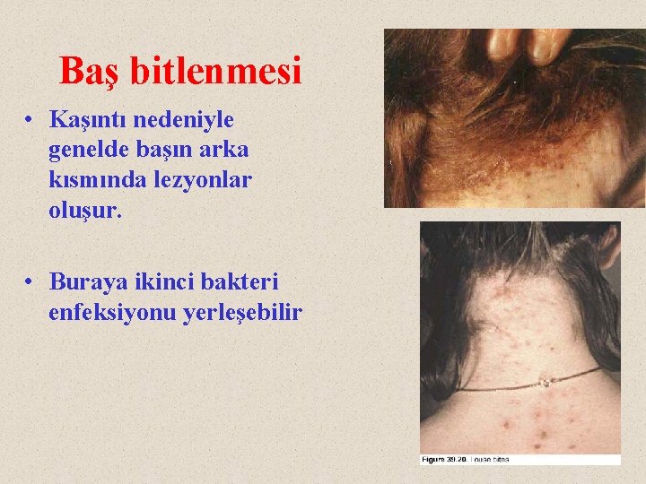 Baş bitlenmesi • Kaşıntı nedeniyle genelde başın arka kısmında lezyonlar oluşur. • Buraya ikinci