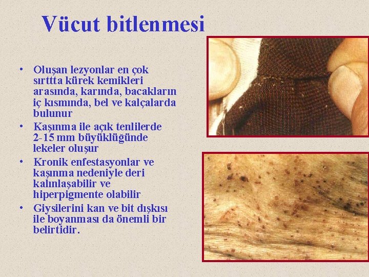 Vücut bitlenmesi • Oluşan lezyonlar en çok sırttta kürek kemikleri arasında, karında, bacakların iç