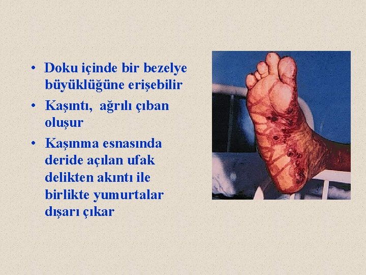  • Doku içinde bir bezelye büyüklüğüne erişebilir • Kaşıntı, ağrılı çıban oluşur •