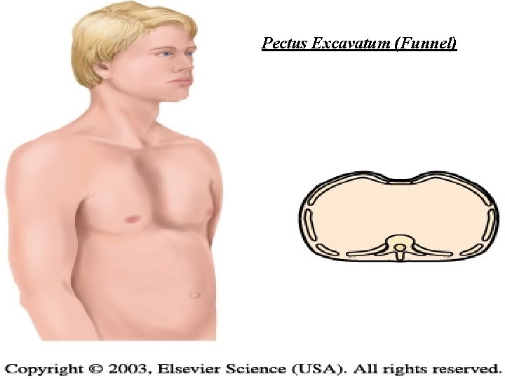 Pectus Excavatum (Funnel) 