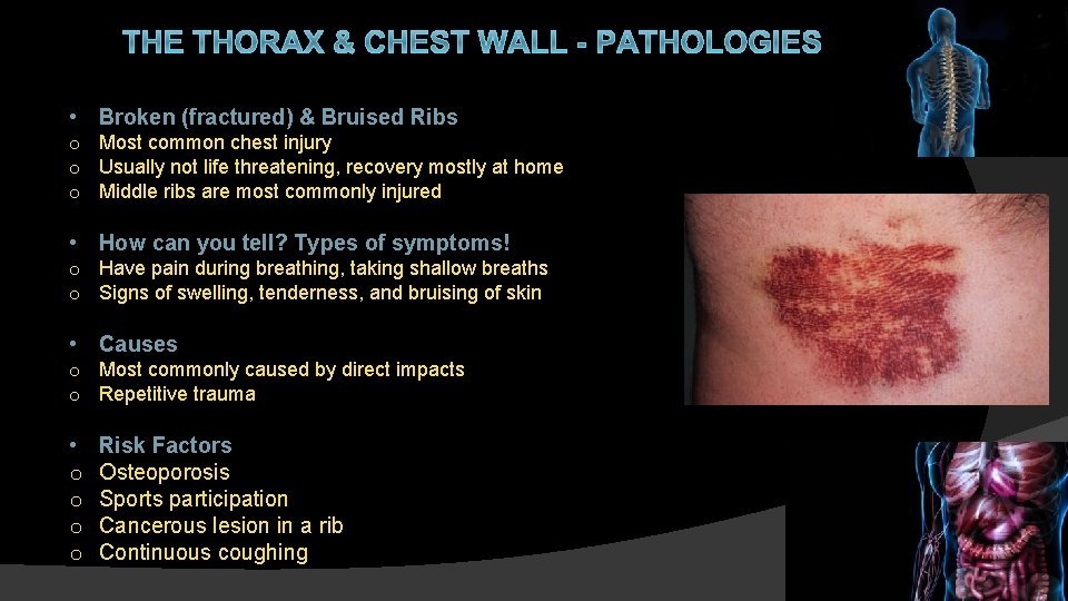 THE THORAX & CHEST WALL - PATHOLOGIES • Broken (fractured) & Bruised Ribs o