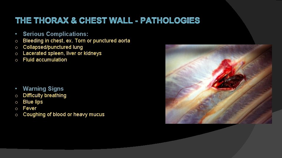 THE THORAX & CHEST WALL - PATHOLOGIES • Serious Complications: o o Bleeding in