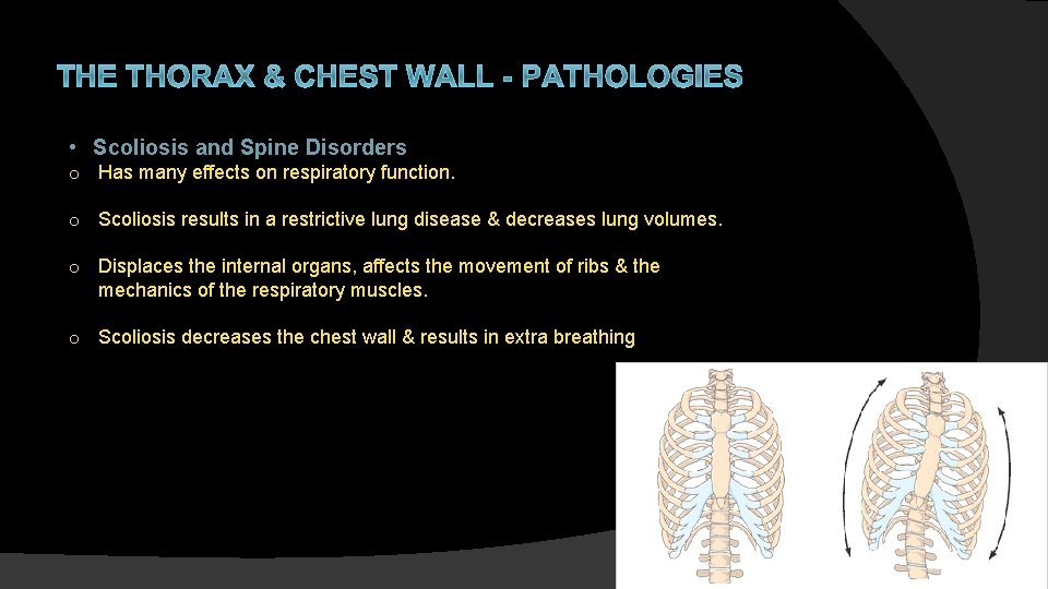 THE THORAX & CHEST WALL - PATHOLOGIES • Scoliosis and Spine Disorders o Has