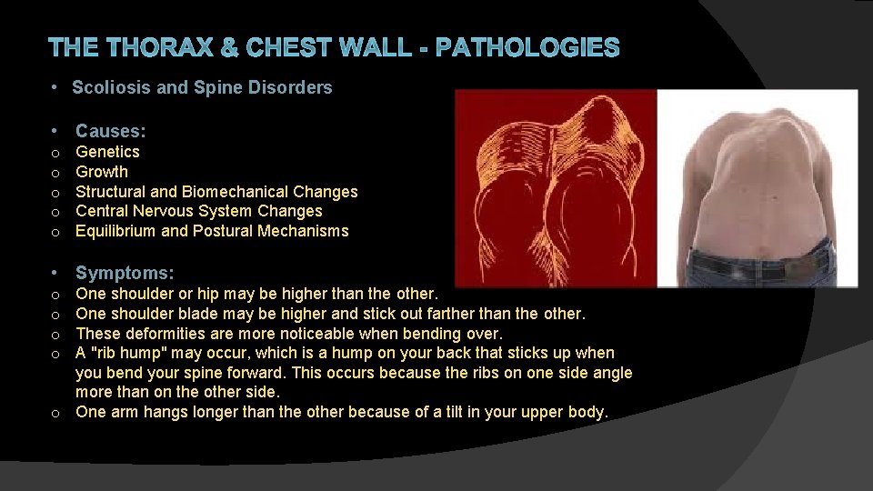 THE THORAX & CHEST WALL - PATHOLOGIES • Scoliosis and Spine Disorders • Causes: