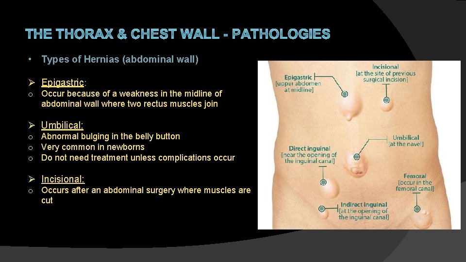 THE THORAX & CHEST WALL - PATHOLOGIES • Types of Hernias (abdominal wall) Ø