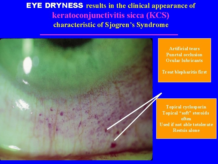 EYE DRYNESS results in the clinical appearance of keratoconjunctivitis sicca (KCS) characteristic of Sjogren’s