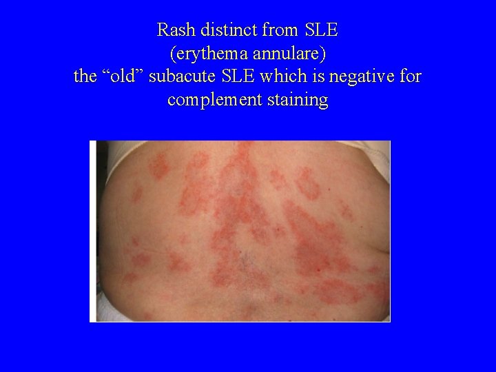 Rash distinct from SLE (erythema annulare) the “old” subacute SLE which is negative for