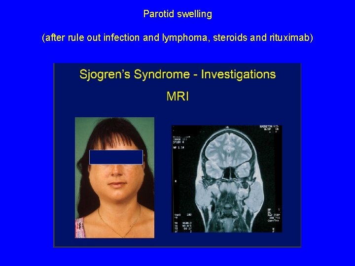 Parotid swelling (after rule out infection and lymphoma, steroids and rituximab) 