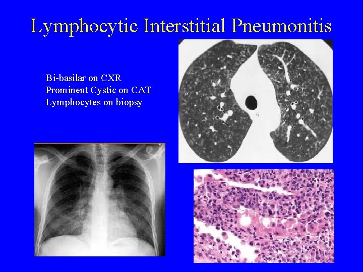 Lymphocytic Interstitial Pneumonitis Bi-basilar on CXR Prominent Cystic on CAT Lymphocytes on biopsy 