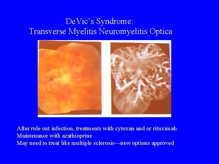 De. Vic’s Syndrome: Transverse Myelitis Neuromyelitis Optica After rule out infection, treatments with cytoxan