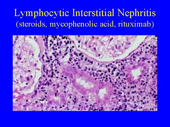 Lymphocytic Interstitial Nephritis (steroids, mycophenolic acid, rituximab) 