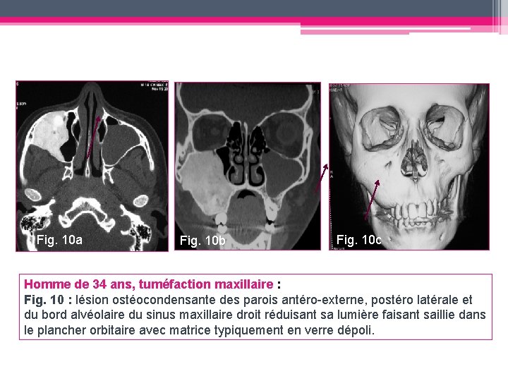 Fig. 10 a Fig. 10 b Fig. 10 c Homme de 34 ans, tuméfaction