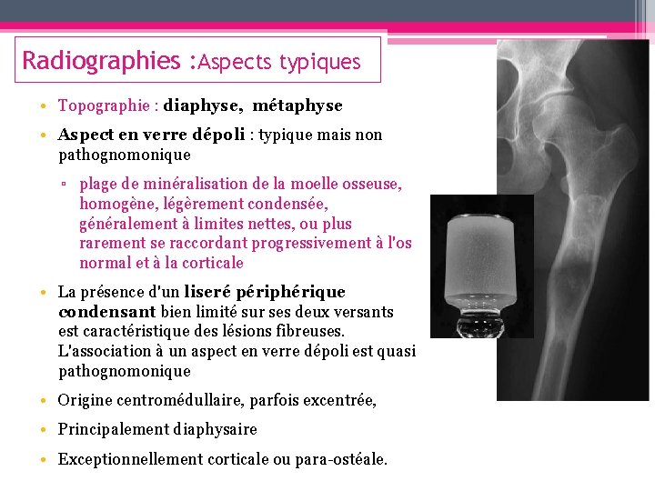 Radiographies : Aspects typiques • Topographie : diaphyse, métaphyse • Aspect en verre dépoli