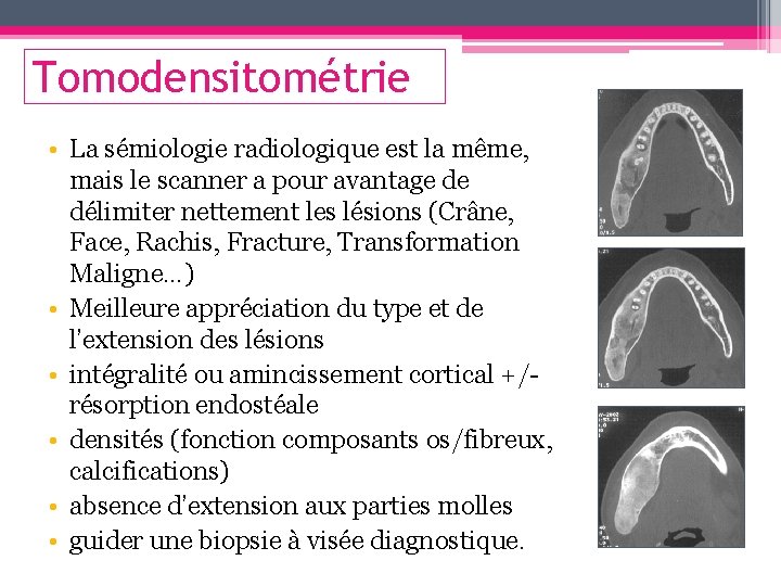 Tomodensitométrie • La sémiologie radiologique est la même, mais le scanner a pour avantage