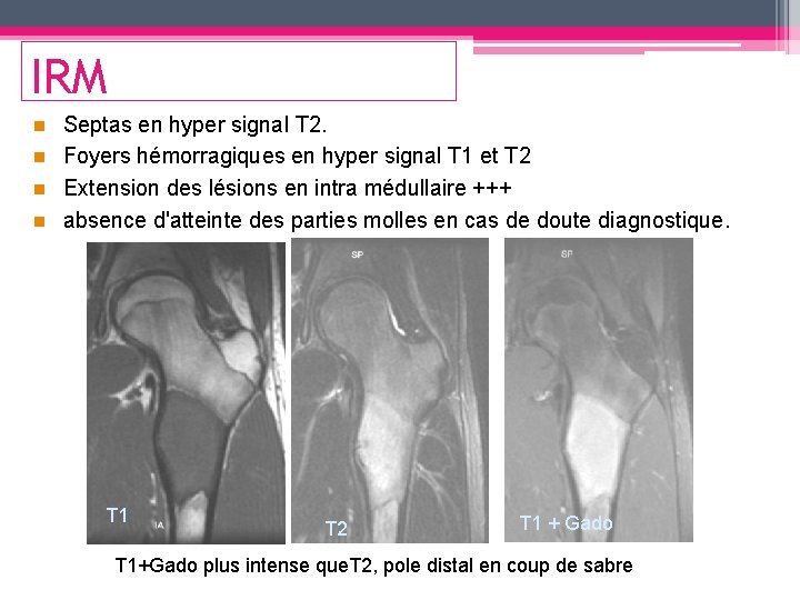 IRM Septas en hyper signal T 2. n Foyers hémorragiques en hyper signal T