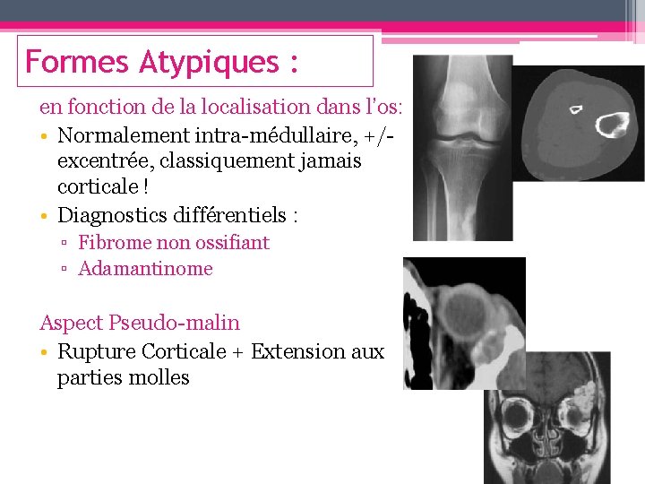 Formes Atypiques : en fonction de la localisation dans l’os: • Normalement intra-médullaire, +/-