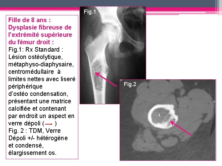 Fig. 1 Fille de 8 ans : Dysplasie fibreuse de l’extrémité supérieure du fémur