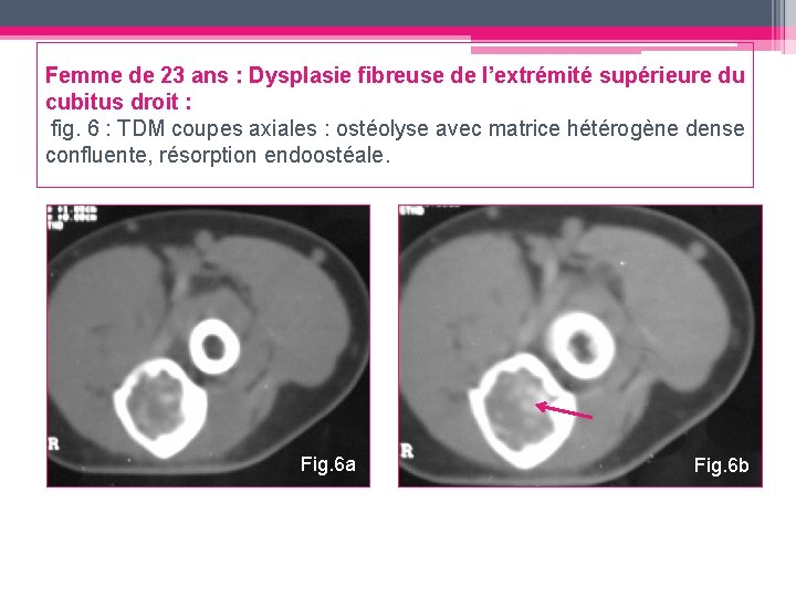 Femme de 23 ans : Dysplasie fibreuse de l’extrémité supérieure du cubitus droit :