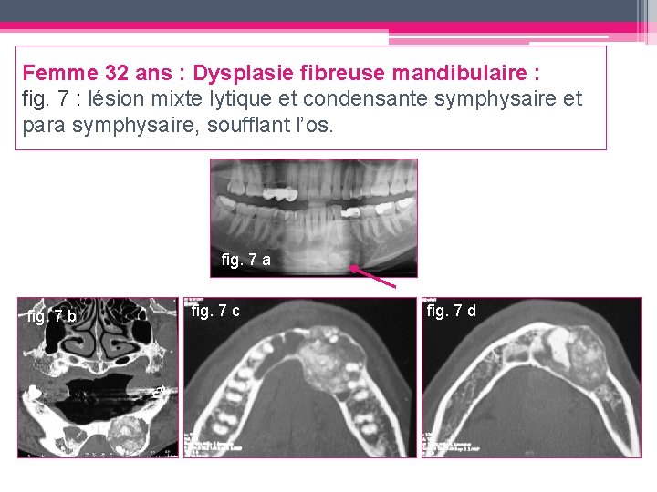 Femme 32 ans : Dysplasie fibreuse mandibulaire : fig. 7 : lésion mixte lytique