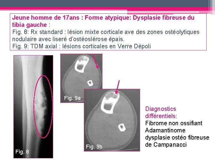 Jeune homme de 17 ans : Forme atypique: Dysplasie fibreuse du tibia gauche :