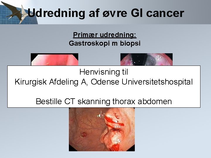 Udredning af øvre GI cancer Primær udredning: Gastroskopi m biopsi Henvisning til Kirurgisk Afdeling