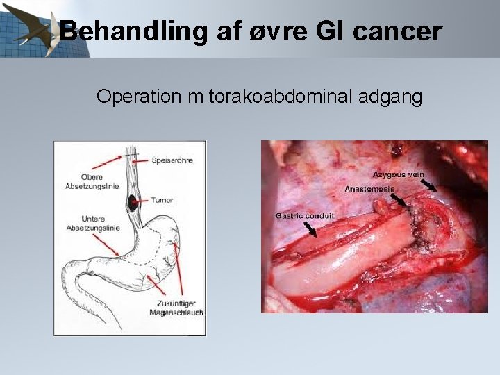 Behandling af øvre GI cancer Operation m torakoabdominal adgang 
