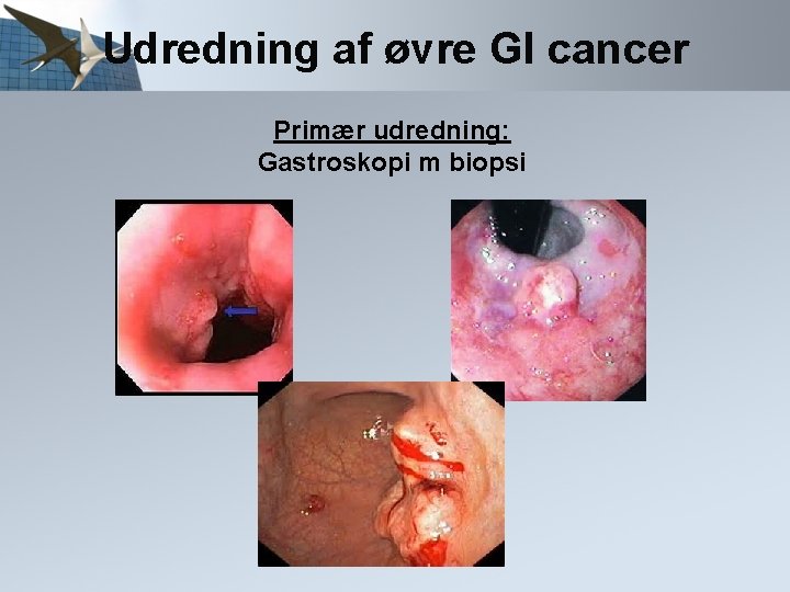 Udredning af øvre GI cancer Primær udredning: Gastroskopi m biopsi 