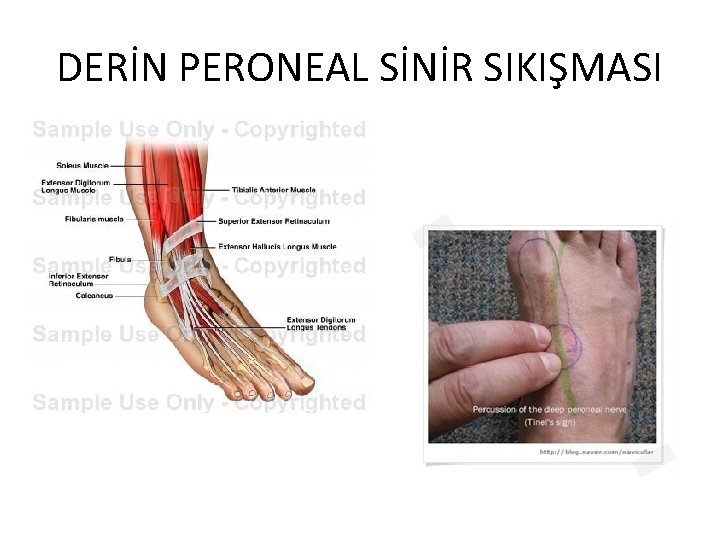 DERİN PERONEAL SİNİR SIKIŞMASI 