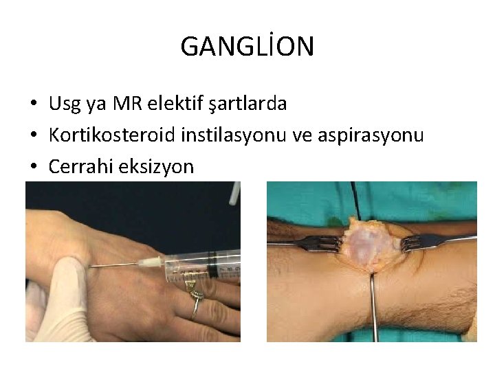 GANGLİON • Usg ya MR elektif şartlarda • Kortikosteroid instilasyonu ve aspirasyonu • Cerrahi