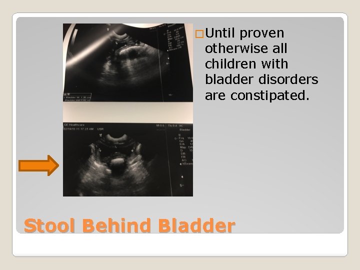 �Until proven otherwise all children with bladder disorders are constipated. Stool Behind Bladder 