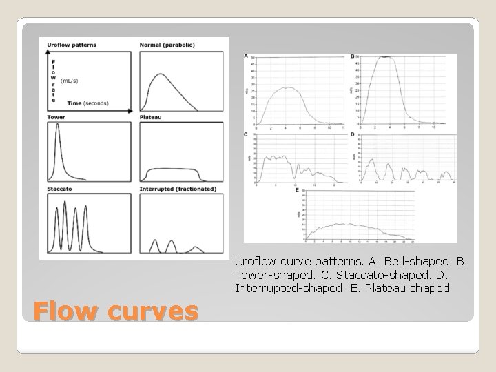 Uroflow curve patterns. A. Bell-shaped. B. Tower-shaped. C. Staccato-shaped. D. Interrupted-shaped. E. Plateau shaped
